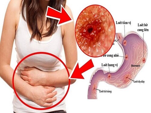 Người bị viêm dạ dày hạn chế ăn lựu